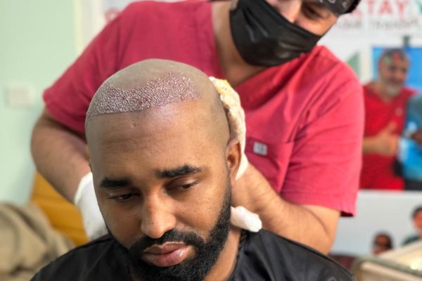 bayleaf-hair-transplant